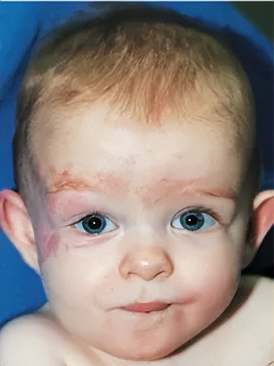 治疗婴幼儿血管瘤的特效药物——盐酸普萘洛尔口服液上市