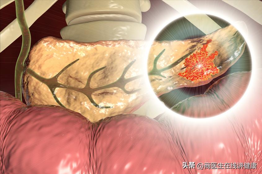 胰腺癌发现就是晚期吗,胰腺癌晚期出现打嗝症状怎么治疗