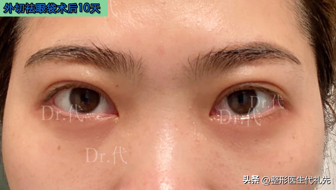 40岁去眼袋手术后效果,外切眼袋手术失败后二次修复