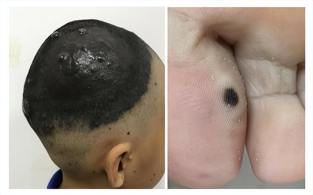 色素痣割了会不会转为黑色素瘤,针眼大的色素痣会癌变么