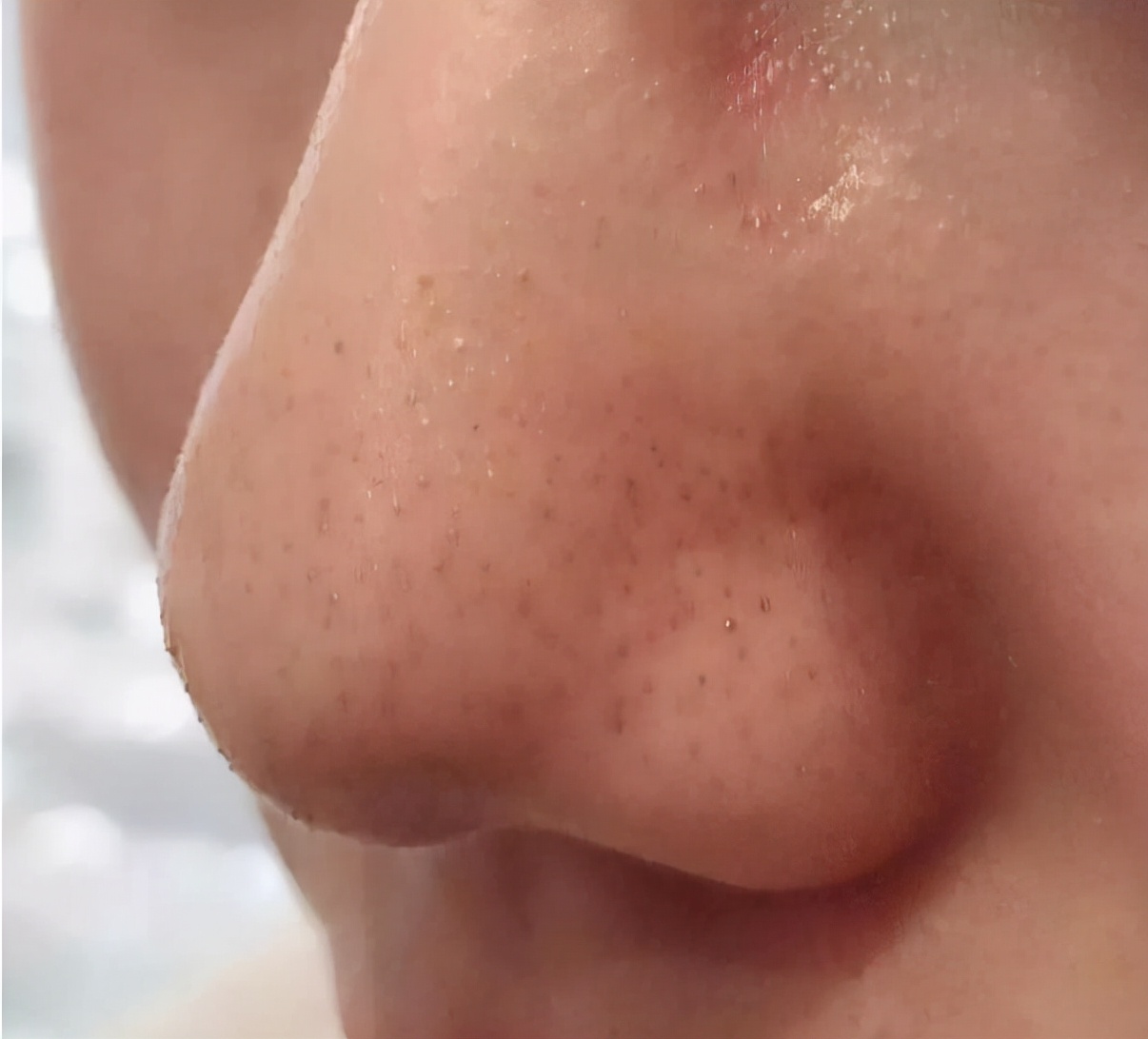 鼻子上挤出来的白色絮状是什么,鼻子挤压出现的白色条状物