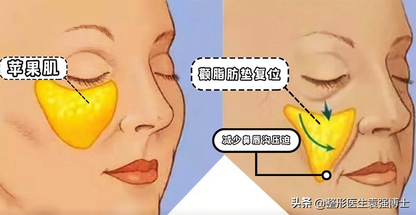 40岁去法令纹最好的方法,40岁就有很深的法令纹