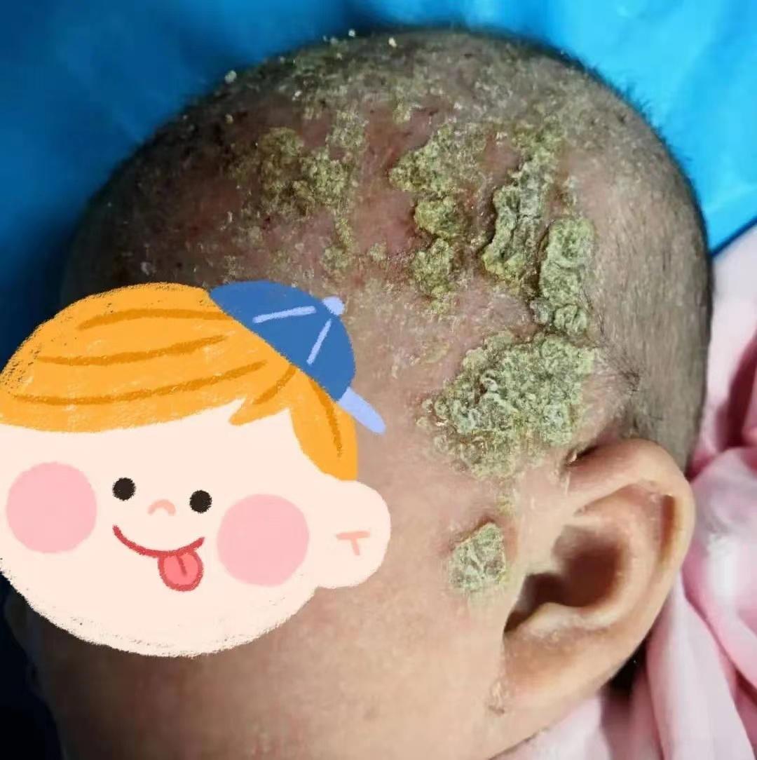 宝宝湿疹不断复发怎么办,小孩儿湿疹反复复发怎么办