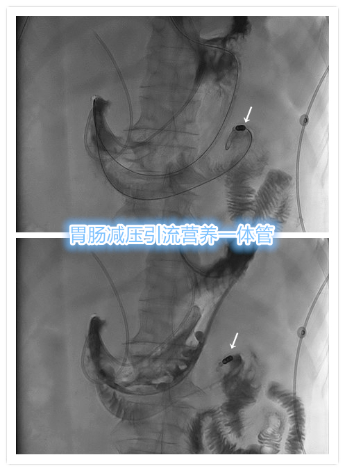 十二指肠切除手术后胃瘫能恢复吗,胃管引流治疗胃瘫