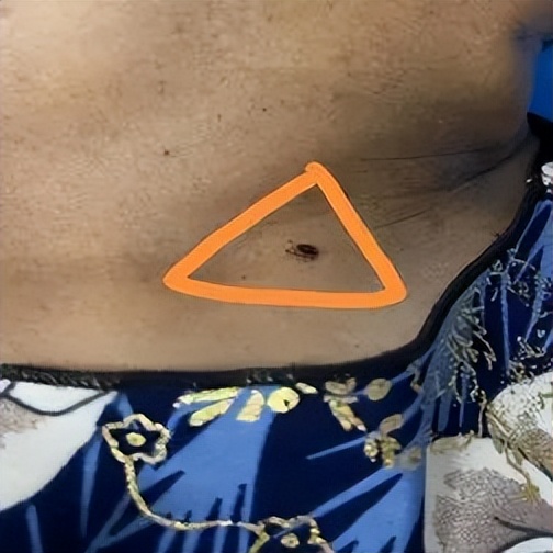 蜱虫的危害性有多大,健康知识野外郊游谨防蜱虫