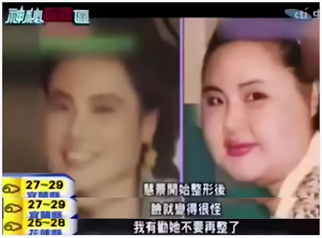 韩慧景整容是打了玻尿酸了吗,2004年整容狂魔韩慧景的故事