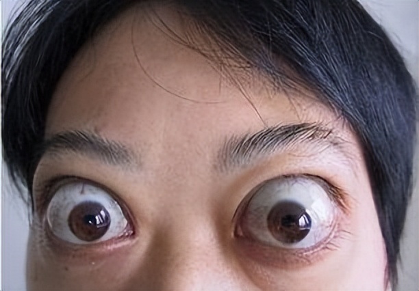 引起甲亢危象的原因是哪些,更年期甲亢是什么原因引起的