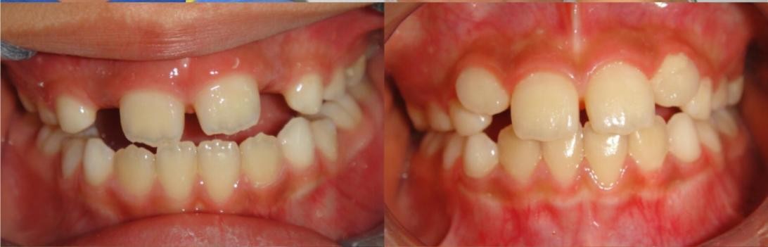 徐州儿童牙齿矫正牙齿不齐,大连口腔医院儿童牙齿矫正怎么样