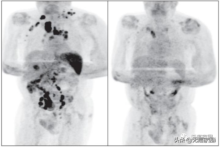 car-t细胞疗法会复发吗,car-t疗法真的能让癌细胞一针清零