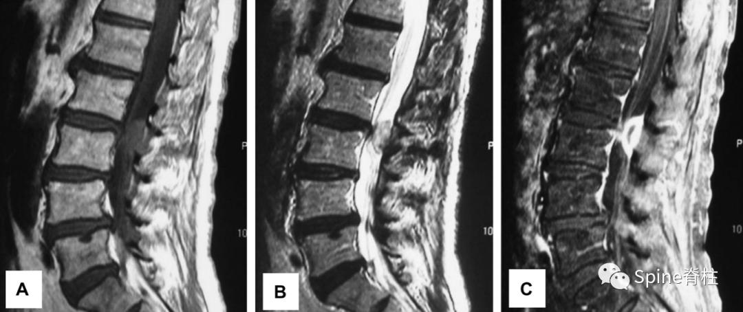 腰椎间盘突出症的治疗方法,腰椎间盘突出症状主要有哪些