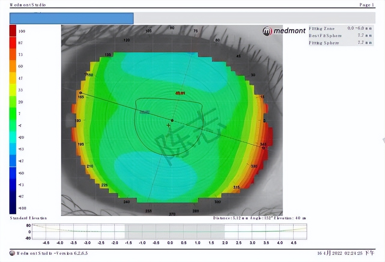 角膜接触镜验配案例图解,戴角膜塑形镜反复出现点染的原因