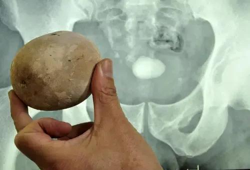 如何缓解尿频强迫症,着凉尿频怎么缓解