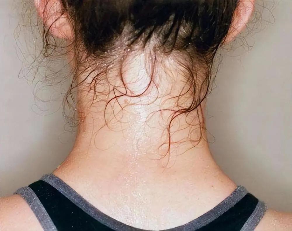 头颈部爱出汗,头部容易出汗中医认为是什么原因