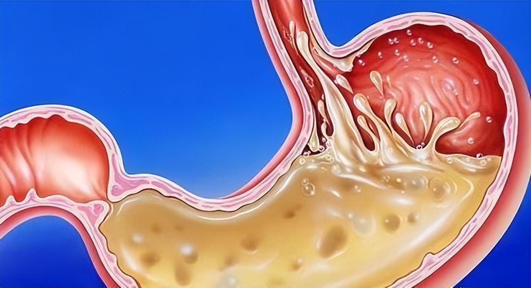 饭后经常反酸烧心是怎么回事,饭后感觉胃烧心平时怎么调理