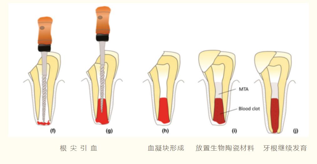 18岁大门牙断牙修复最佳方法,大门牙缺了牙髓没了