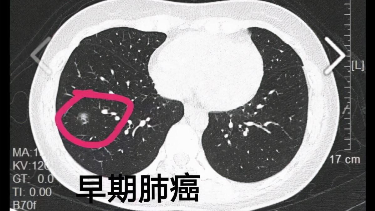 咽喉炎肺会有症状吗,如果咽喉肿痛怎么办