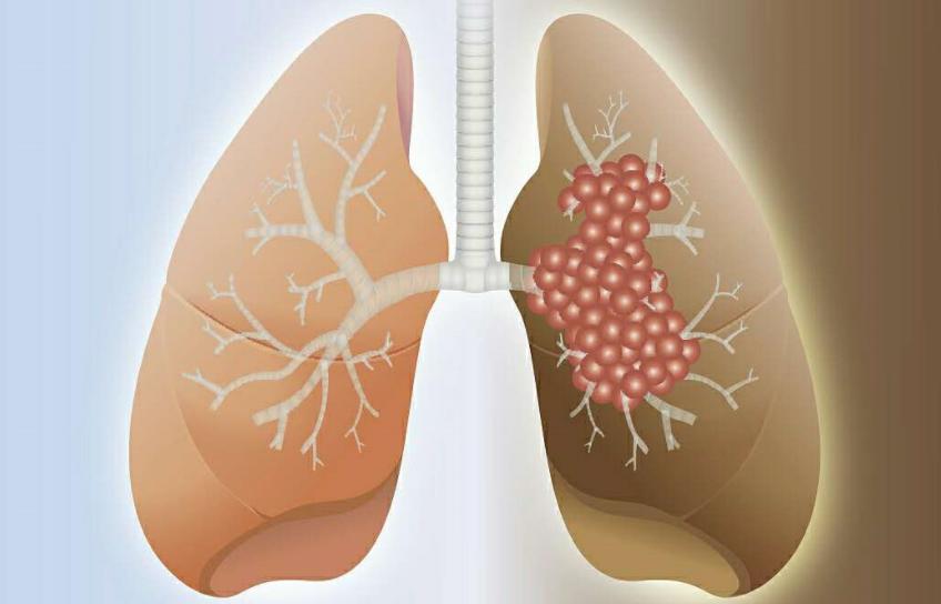 右肩疼了6个月查出肺癌，身上5处出现疼痛，或是癌症和疾病的征兆