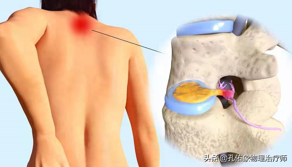 神经根颈椎病的症状和治疗方法,椎动脉颈椎病的症状和治疗方法