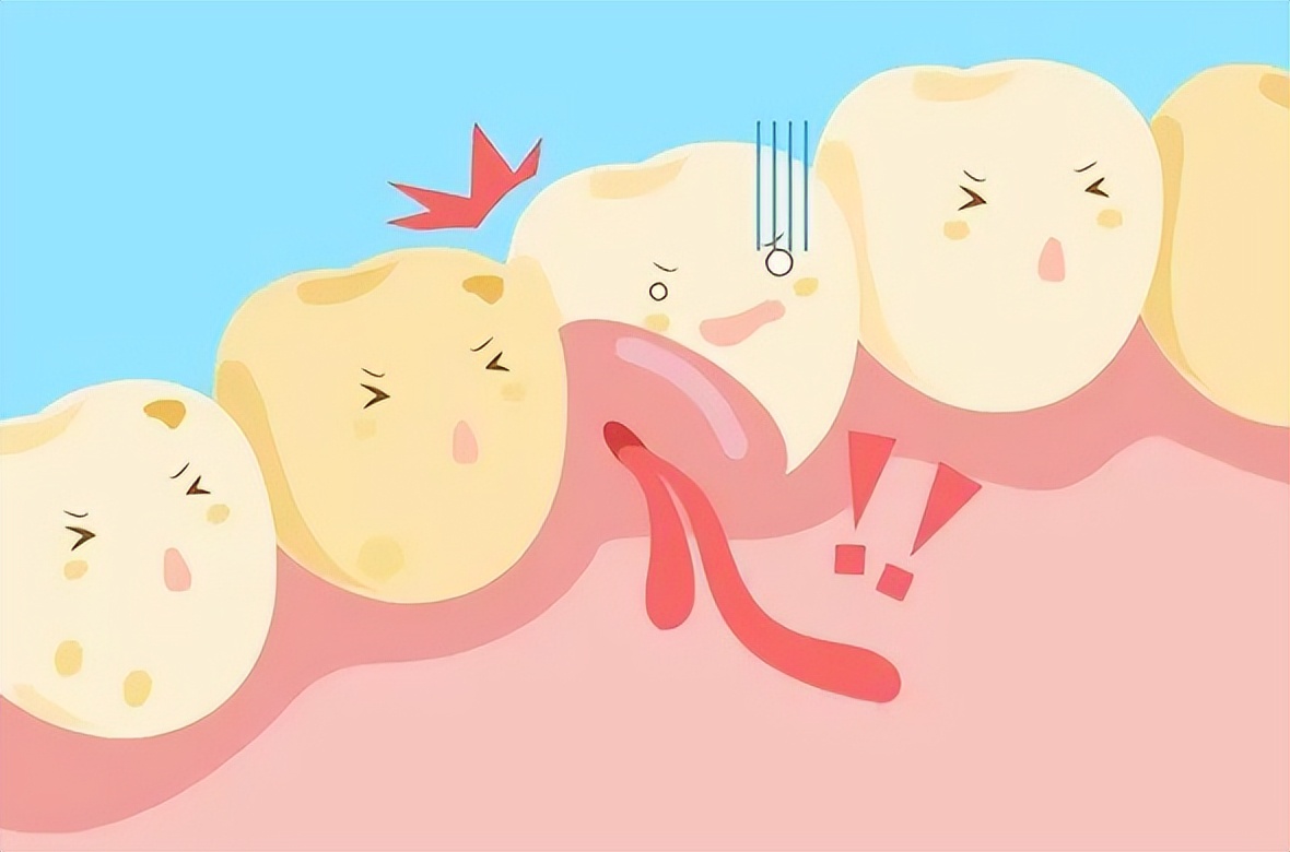 牙龈突然肿了个肉坨图片,牙龈肿了个肉坨是怎么回事呀