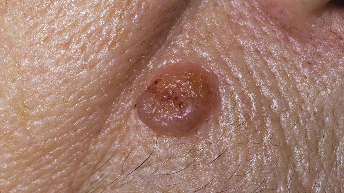 脸上长黑斑是癌症的前兆吗,脸上的黑斑会成皮肤癌吗