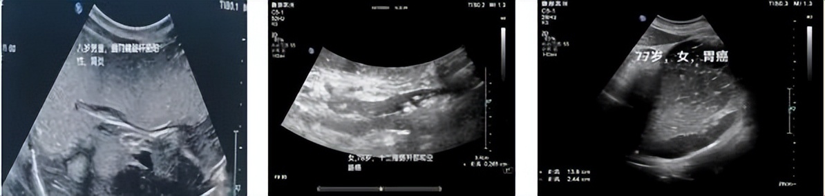 济宁市哪家医院有超声波胃镜,济宁市人民医院做胃镜快吗