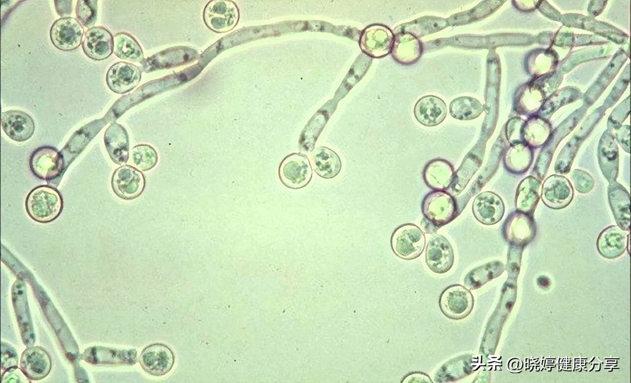 月经期间阴道酵母菌感染的预防