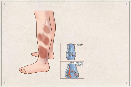 单腿小腿酸胀发麻是静脉曲张吗,腿酸胀难受怎么缓解静脉曲张