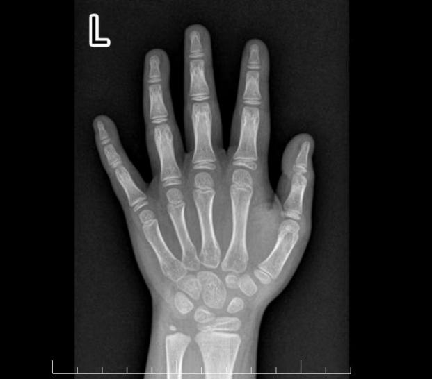 女童肥胖早熟治疗方法,儿童肥胖导致早熟未成年