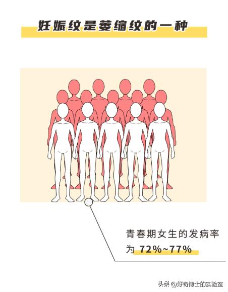 大腿上有白色条纹怎么回事,女生大腿外侧有红条纹是什么原因