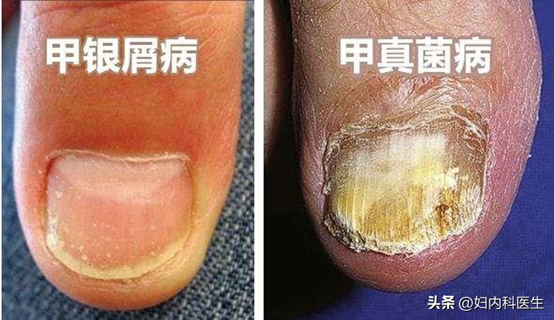 得了灰指甲不治疗会怎么样,灰指甲症状与治疗的费用大概多少