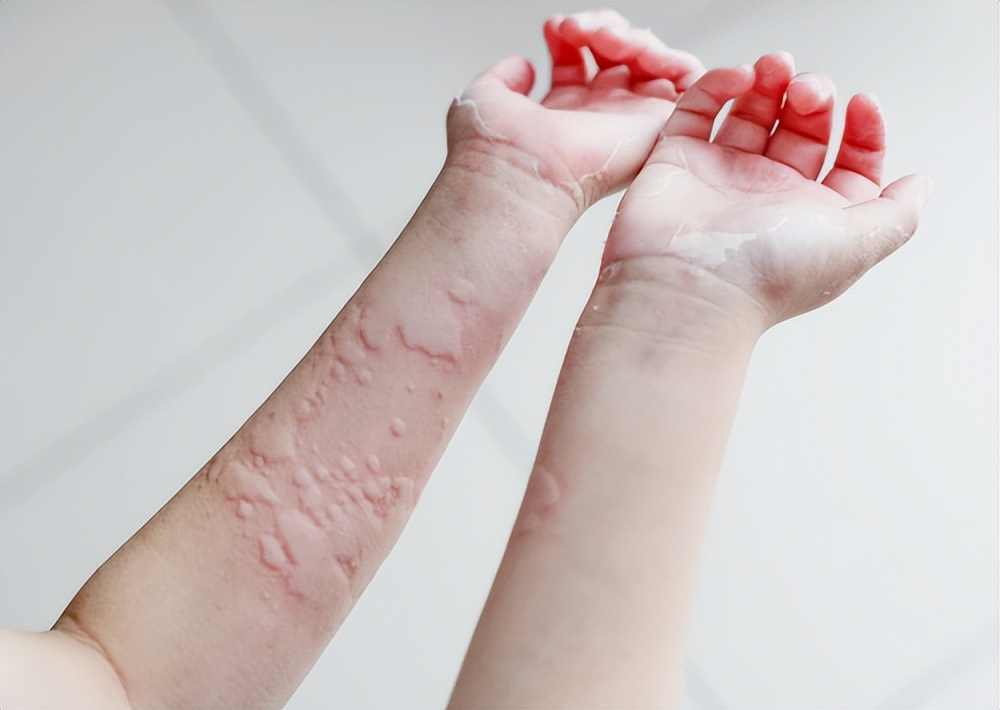 生活中最常见的4种皮肤病,皮肤科可以看多种皮肤病吗