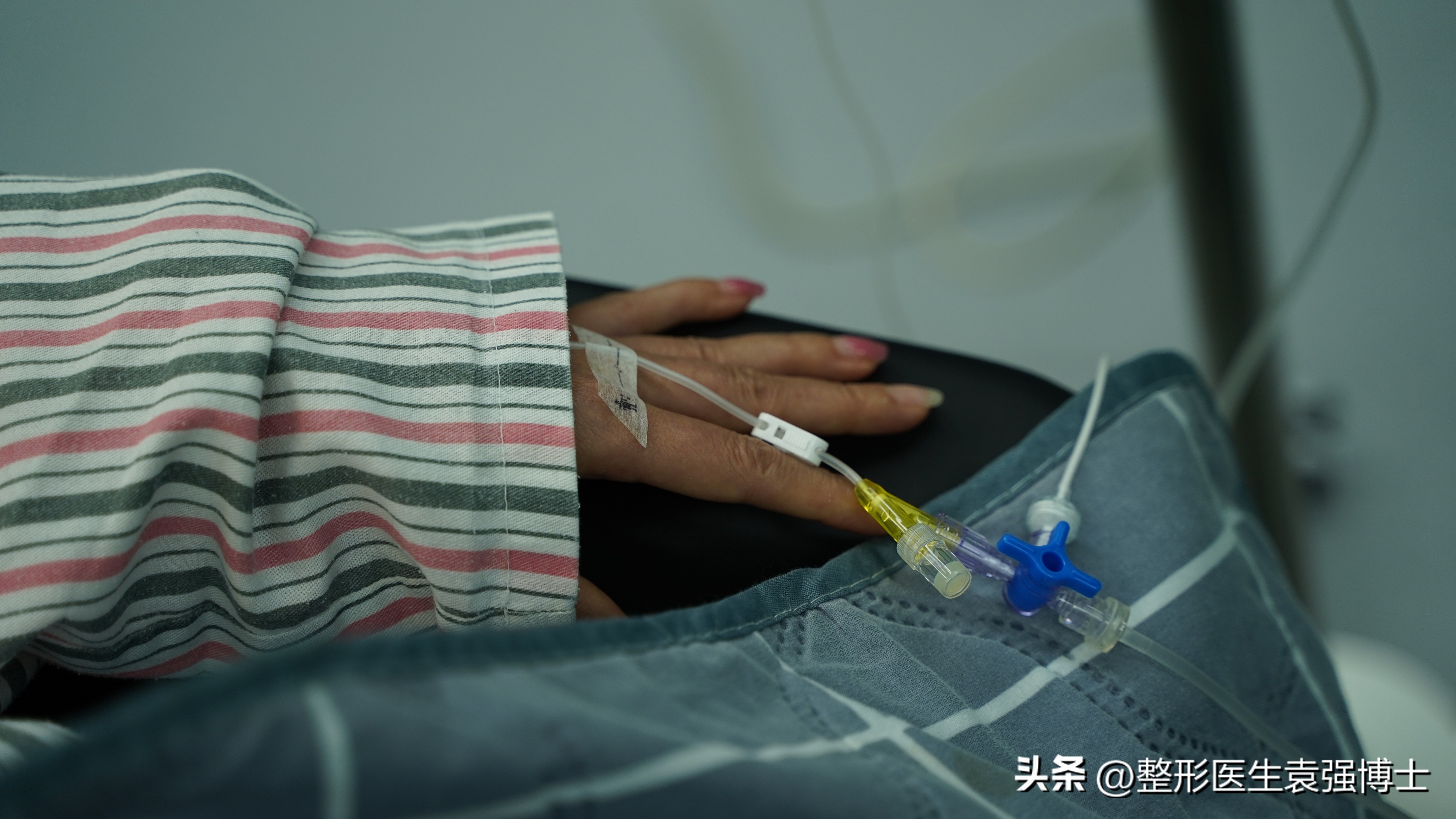 44岁女士拉皮除皱,50岁女人面部拉皮