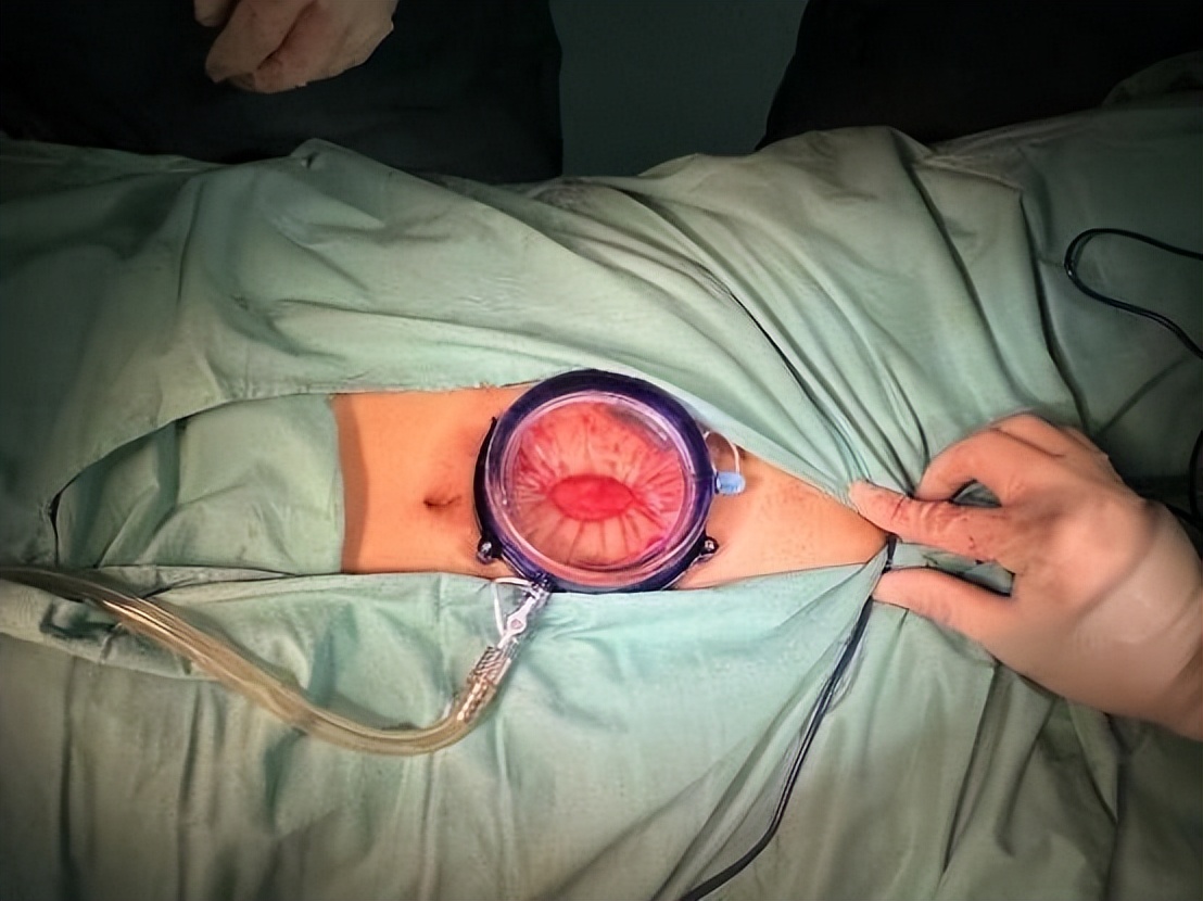 哈医大一院泌尿外科“新辅助”神奇疗法可缩小前列腺肿瘤为晚期前列腺癌治疗带来新方案