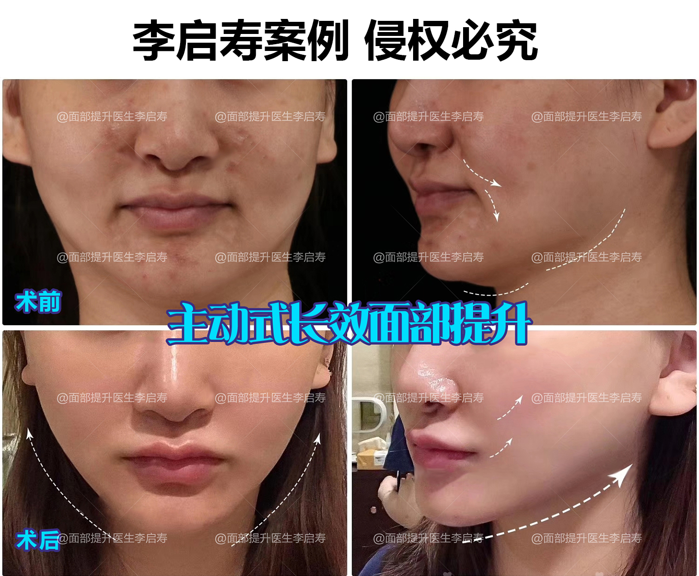 面部提升整形失败如何修复,面部提升年轻化术真实案例