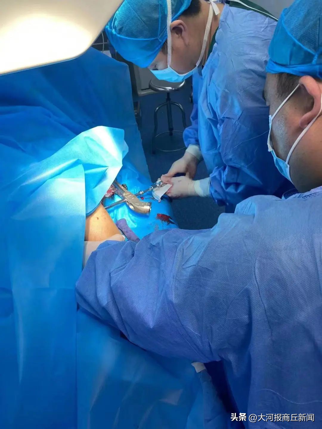 骨科医生腓骨骨折复位固定成功,骨科切开复位内固定