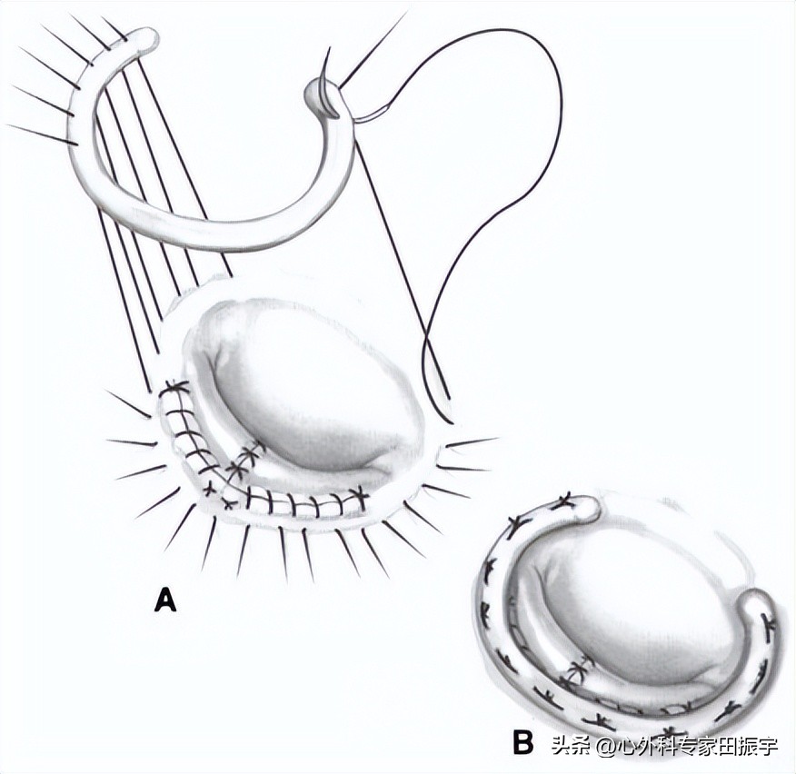 二尖瓣成形术要多少钱,二尖瓣成形术后抗凝多久