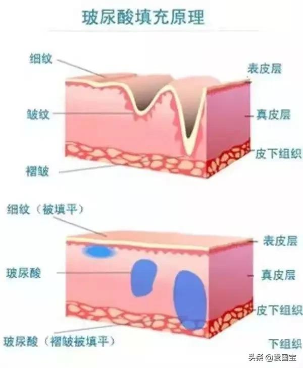 探索玻尿酸蓝海市场,玻尿酸1000亿市场
