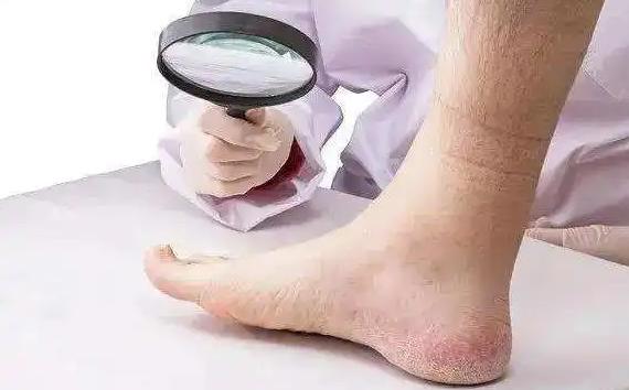 日本人如何处理脚气问题,欧美人为什么更容易患脚气