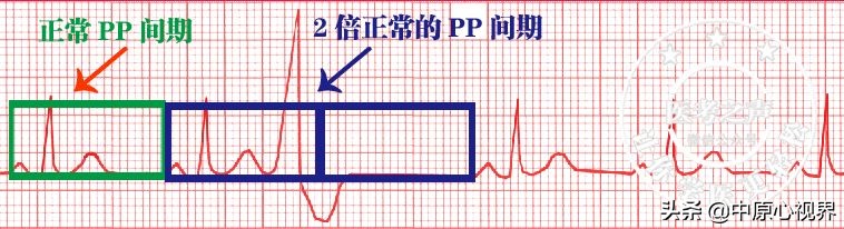 护考几种常见的心电图,常见的心电图图形分析