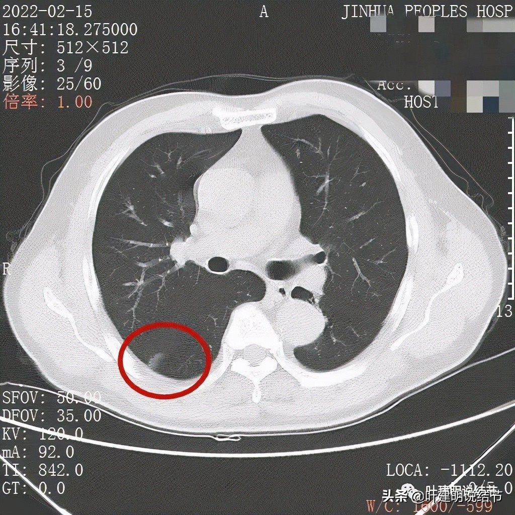 肺腺癌高危亚型什么意思,肺腺癌高危亚型