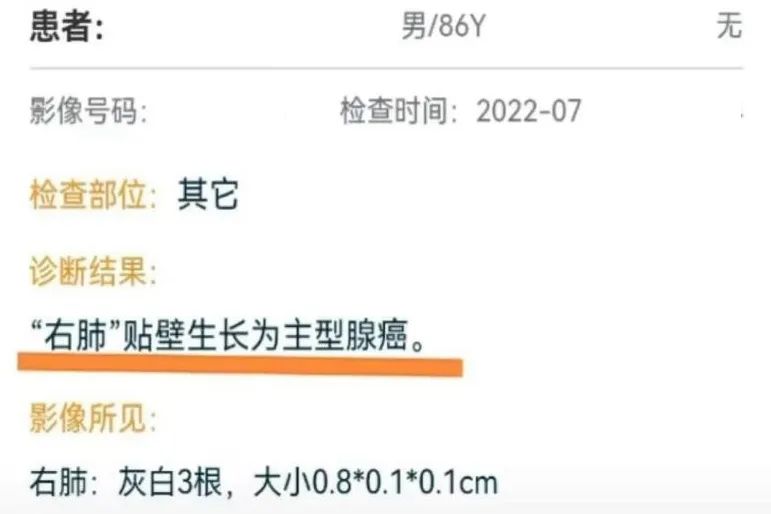 浙江首例！医生用钝头微波消融针为8旬老人“烫死”高危肺结节
