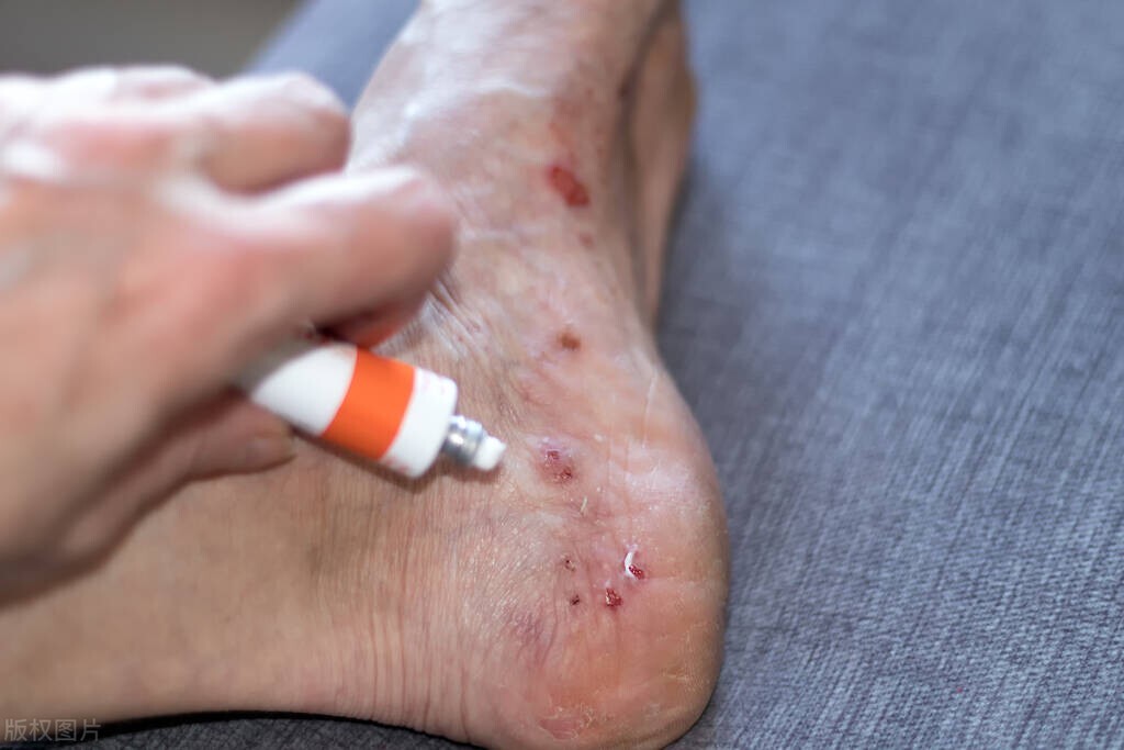 脚气反反复复怎么办？医生教你2个实用小妙招，根治脚气不复发