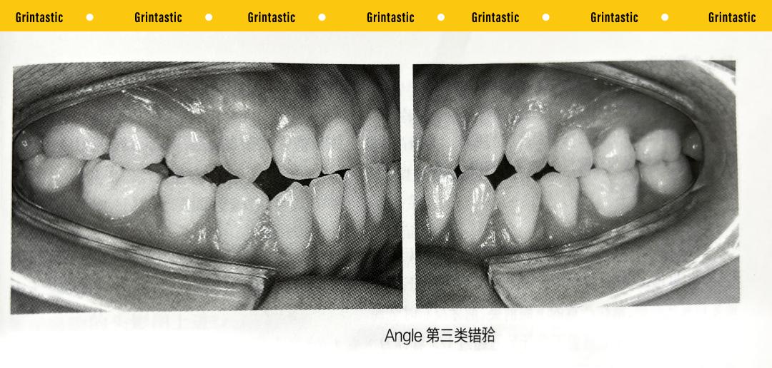 错颌畸形的分类方法,错颌畸形的检查诊断病例
