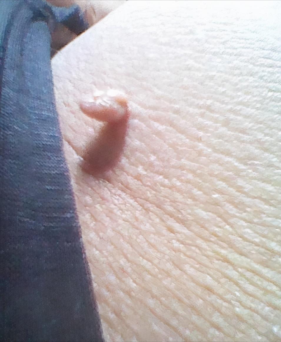 脖子上长小肉粒有什么办法治疗吗,脖子上长小肉粒会治愈么