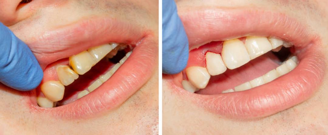 解决牙缝塞牙的办法,牙缝每天都塞牙怎么办