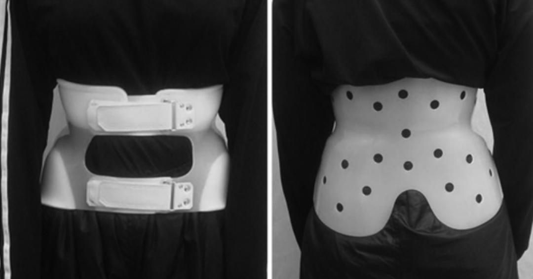 峡部裂和隐性峡部裂有区别吗,单纯峡部裂可以做峡部修复吗