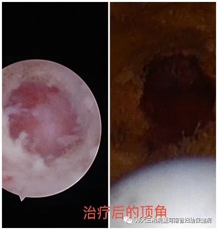 高危hpv1652自己转阴的概率是多少,hpv高危82型感染了三年了还未转阴