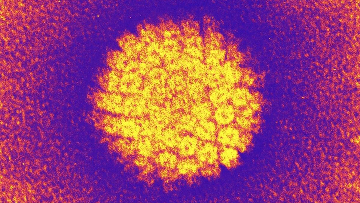 祛除体内湿气会治愈hpv感染吗,hpv湿热型中药