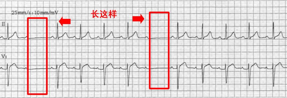 心跳加快不是心动是有病,心跳比较快是心脏病吗