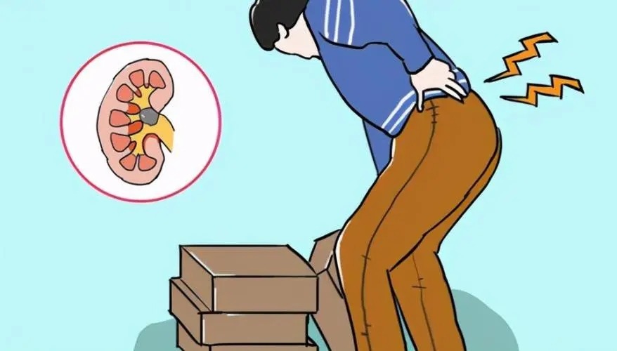 怎么缓解肾结石的痛,怎么缓解肾结石腰疼